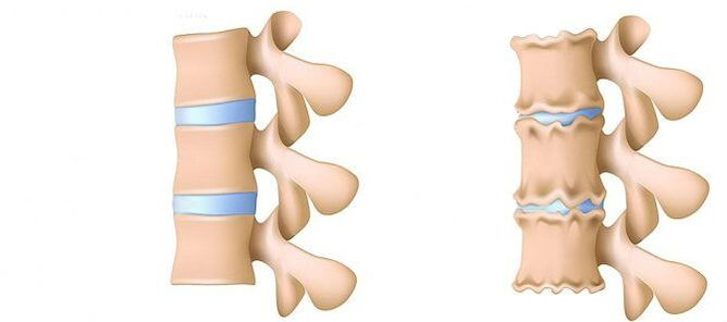 Osteochondroza obszaru lędźwiowego