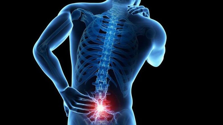 Objawy osteochondrozy lędźwiowej